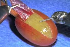 Did You Know That They Did Surgery on a Grape?